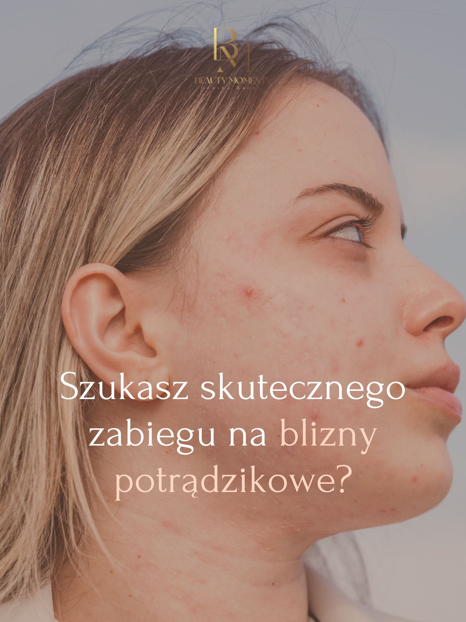 Szukasz skutecznego zabiegu na blizny Sprawdź, dlaczego warto wybrać VIVACE