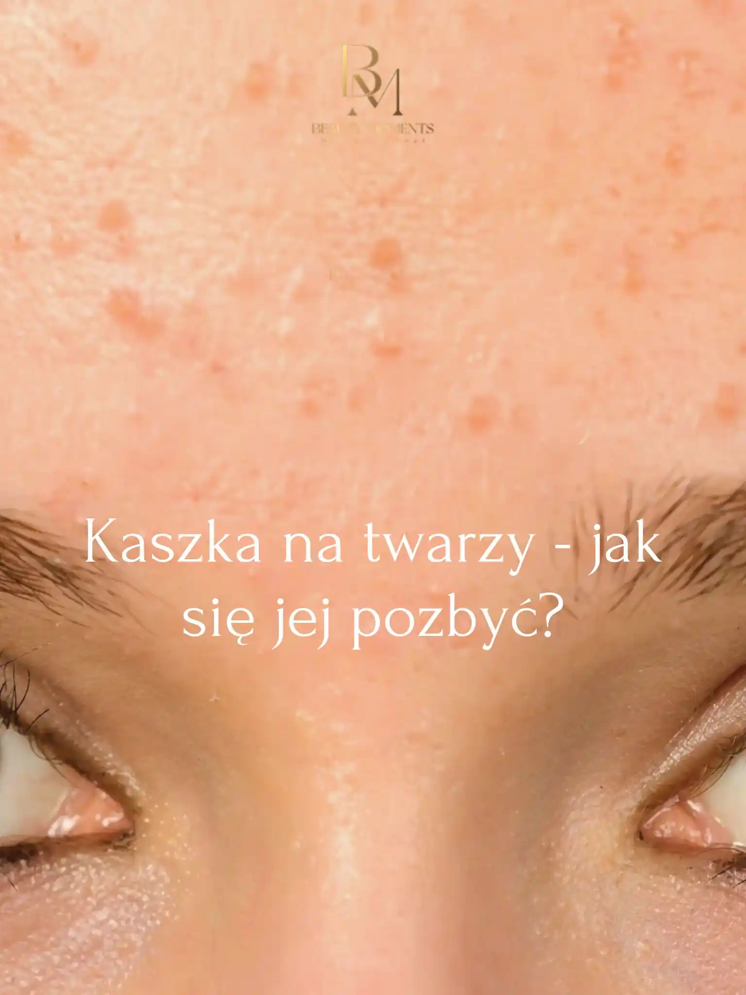 KASZKA NA TWARZY - JAK SIĘ JEJ POZBYĆ_1